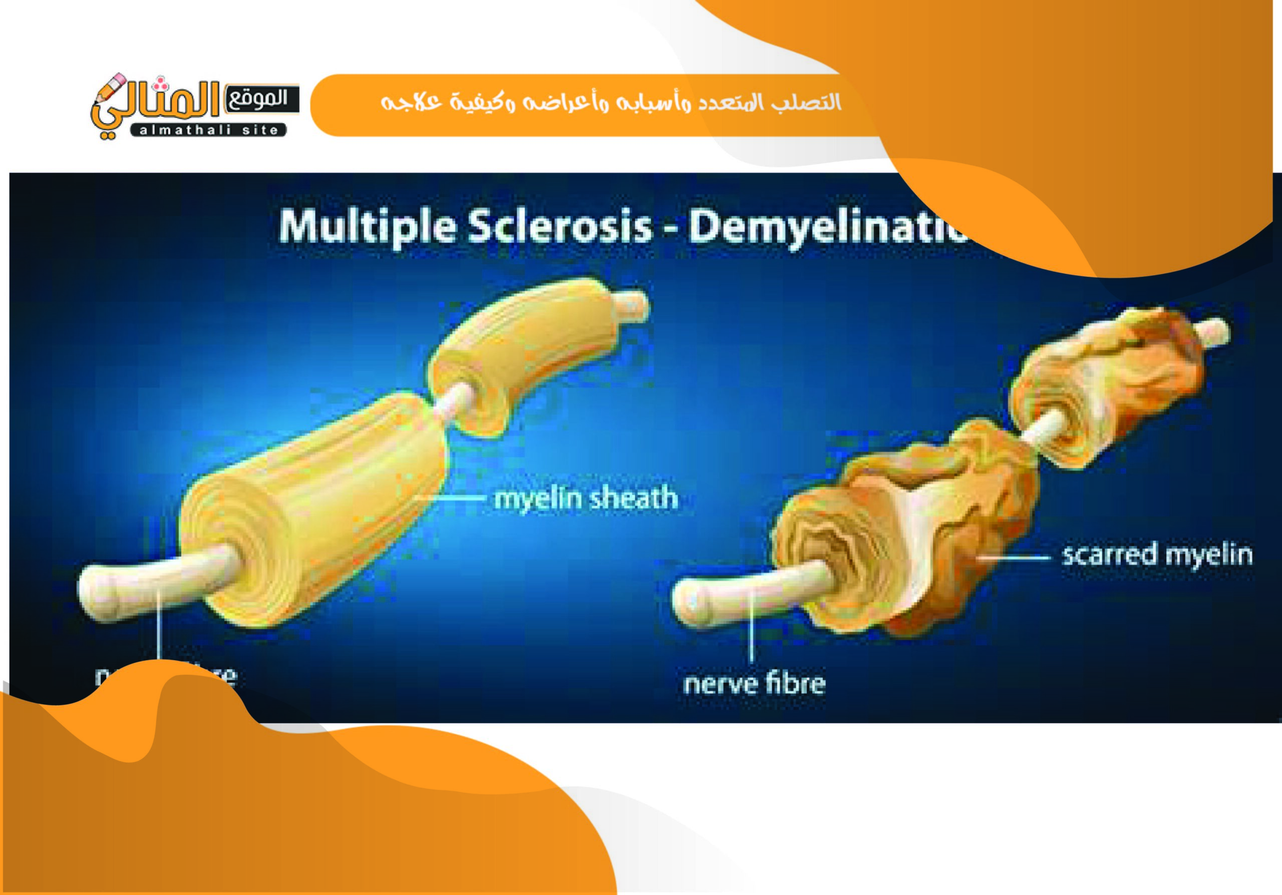 التصلب المتعدد وأسبابه وأعراضه وكيفية علاجه